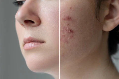Platinum LED acne and skin improvement results